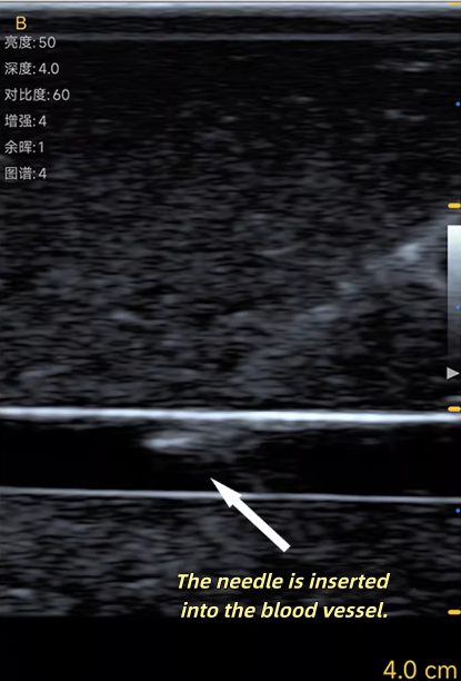 Ultrasound Vascular Puncture T - đánh giá và giá Medical Gel Ultrasound